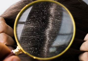 Forfora: come rimuoverla velocemente e in maniera duratura